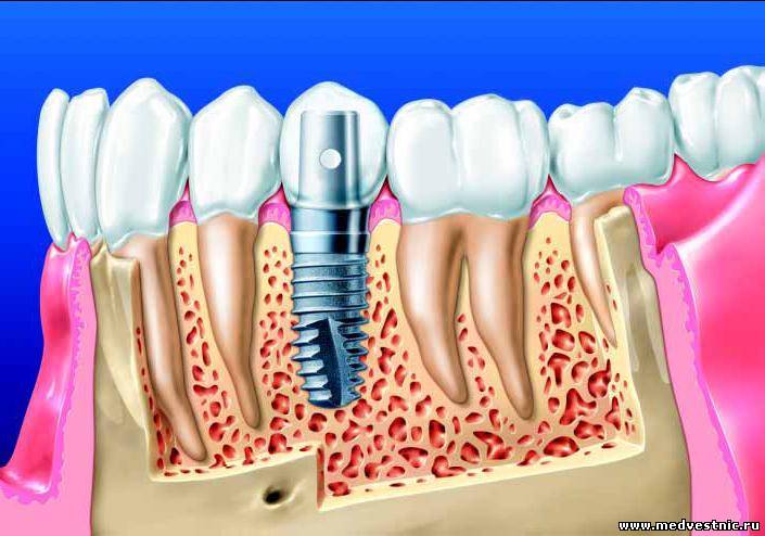 Немного об имплантации зубов